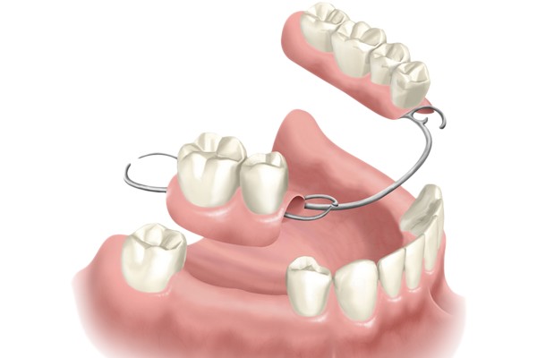 Prótesis dental en La Palma del Condado.